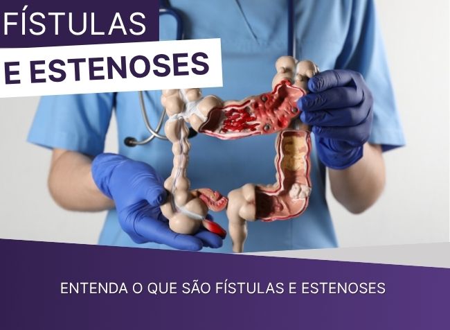 Entenda o que são fístulas e estenoses
