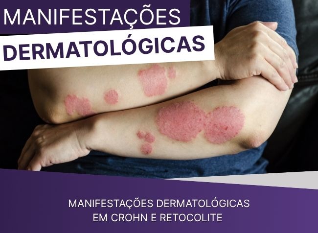 Manifestações dermatológicas em Crohn e Retocolite