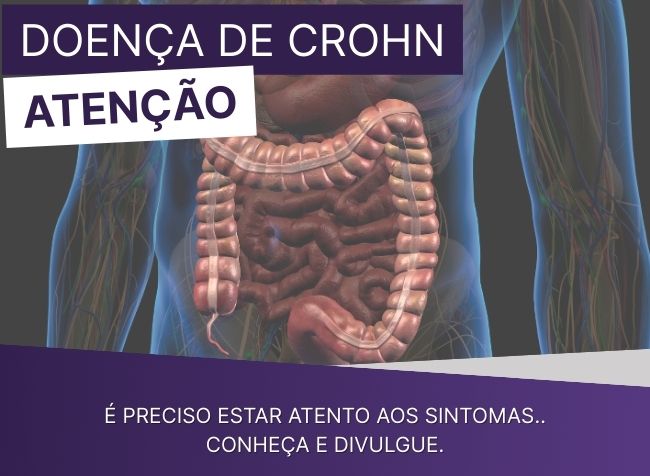 Sintomas da Doença de Crohn: sinais que merecem atenção